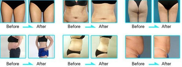 Hot Promotion!!! fat freeze slimming whole body cryotherapy machine