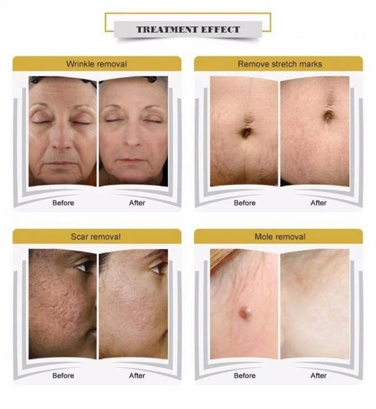 Wrinkle Removal Fractional CO2 Laser Device , Skin Tightening Laser Machine