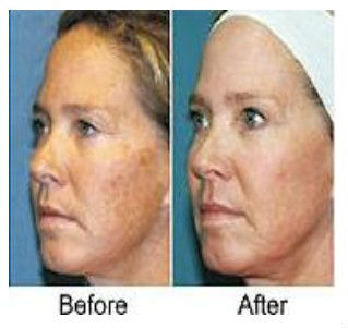 Newest factory direct sale Thermag Skin Treatment Machine