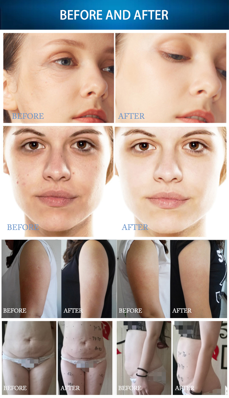 Laser Cellulite Removal Machine , Vacuum Non Surgical Body Contouring Machine