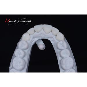Natural Whitening Hollywood Veneers