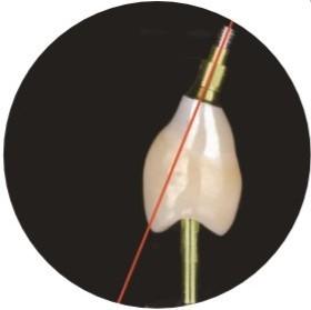 China Natural ASC Angled Screw Channel Dental Implants Crown wholesale