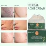 Herbal Anti Acne Cream Scar Remove Treatment Cleansing Face Cream