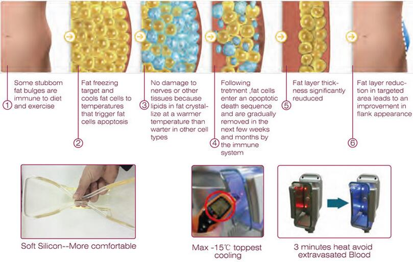 criolipolisis cryotherapy slimming cool Lipo sculpting shape weight loss fat freezing cryolipolysis machine