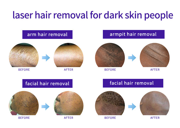 All Skin Types Thread Vein Removal Machine , Vertical Style Laser Acne Removal Machine