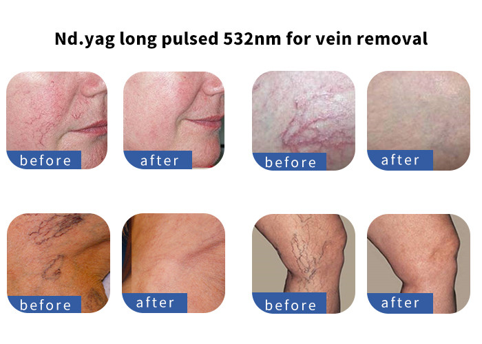 Solid State Laser Hair And Tattoo Removal Machine , Industrial Laser Hair Removal Machine