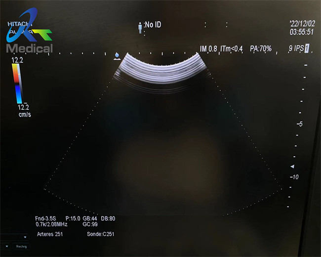 Hitachi Aloka Probe C251 Ultrasound Probe Repair Lens Replacement