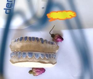 China Custom ISO13485 Bleaching Tray For Whitening Teeth wholesale