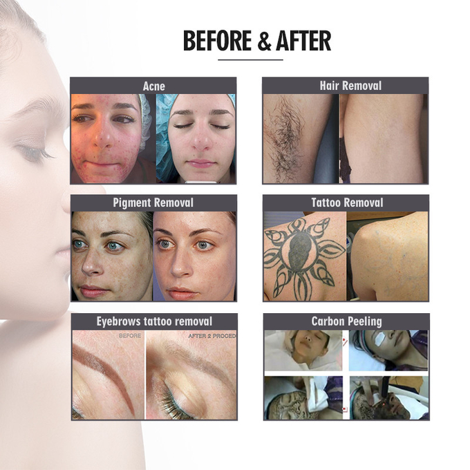 Intense Pulsed Light SHR IPL Machine DPL Skin Rejuvenation Tattoo Removal Multifunctional For Salon