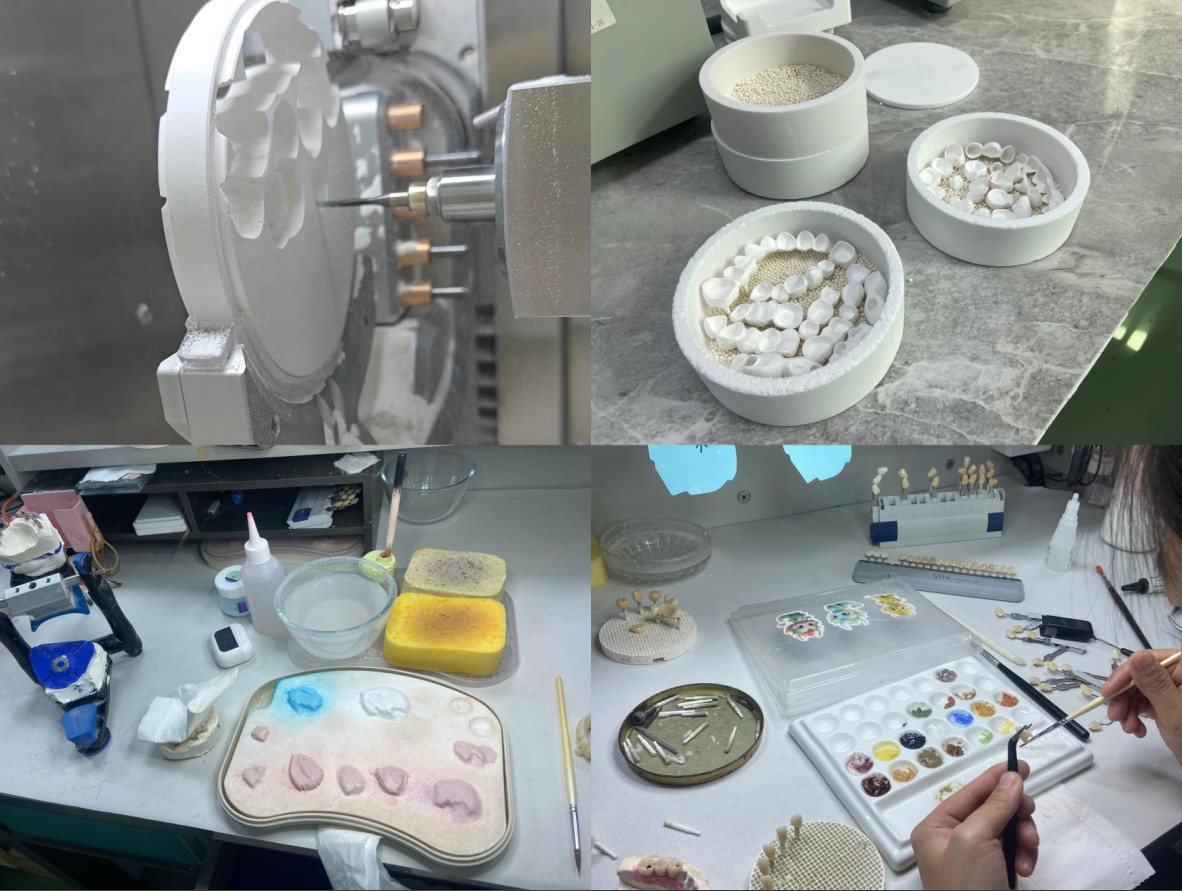 Cosmetic Dentistry EMAX Porcelain Veneers for Beautiful Dental Restorations