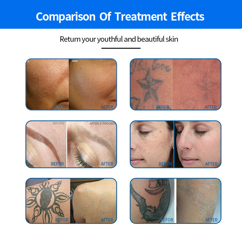 Pigment Removal Q-Switched ND YAG Laser Tattoo Removal ф7 And ф8 Yag Bars