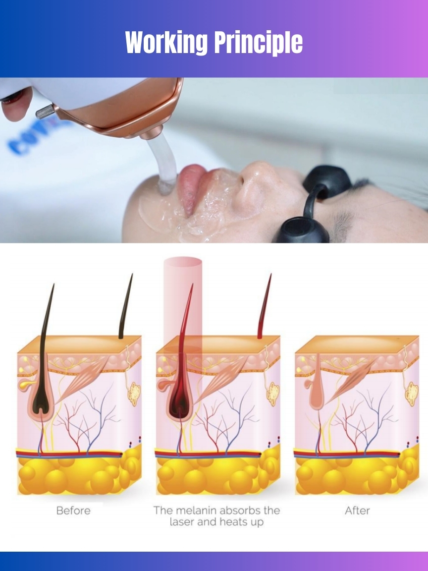755 808 940 1064nm Diode Laser Hair Removal Device 4 Wavelength with 12*24mm/12*28mm Spot Size