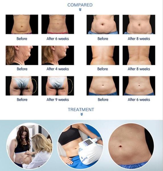 Newest Cryolipolysis Slimming Machine with medical CE certificate