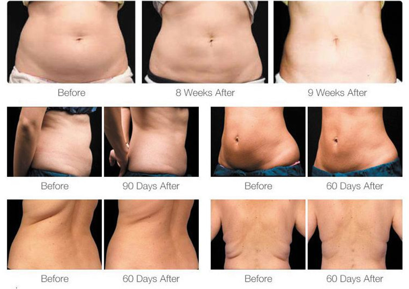 360 Cryolipolysis Slimming Machine Fat Freezing Lymphatic Drainage Device