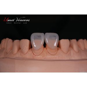 Durable whitening veneer for teeth