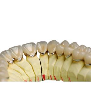 China Dental Laboratory Titanium alloy Porcelain Dental Crown Natural Metal Porcelain Tooth wholesale