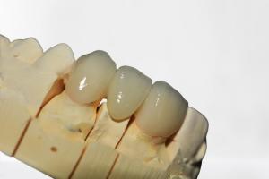 China Beautiful Dental Crown Bridge Wear Natural Restore Chewing Power wholesale
