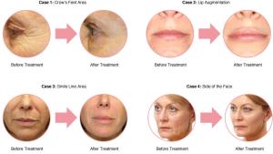 China Top Pure Cross Link Super Hyaluronic Acid Filler for face lift wholesale