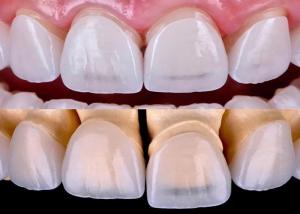 China Long Lasting Dental EMAX Veneer Fabricated With All Ceramic Zirconium Material wholesale