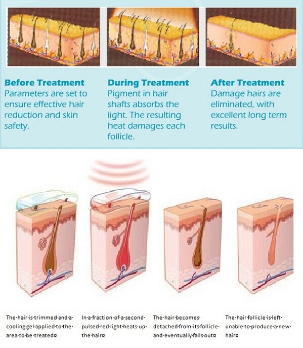 ipl laser hair removal machine nubway,ipl laser home hair removal machine,hair removal ipl laser machine ellipse ipl
