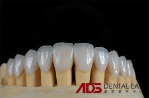 China Feldspathic Porcelain Laminate Dental Veneer Seamless Customized wholesale