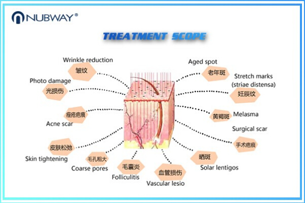 30w Fractional Co2 Laser Nubway Products Vaginal Applicator