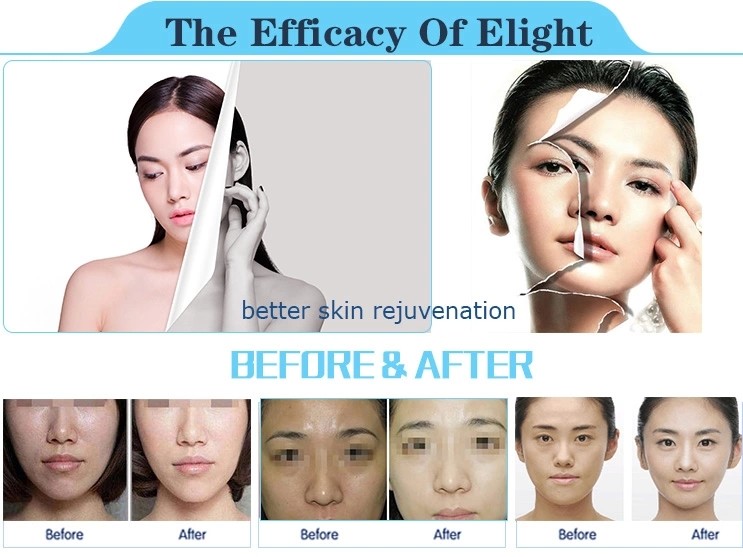 IPL laser hair removal machine nubway laser home hair removal machine ipl beauty salon equipment