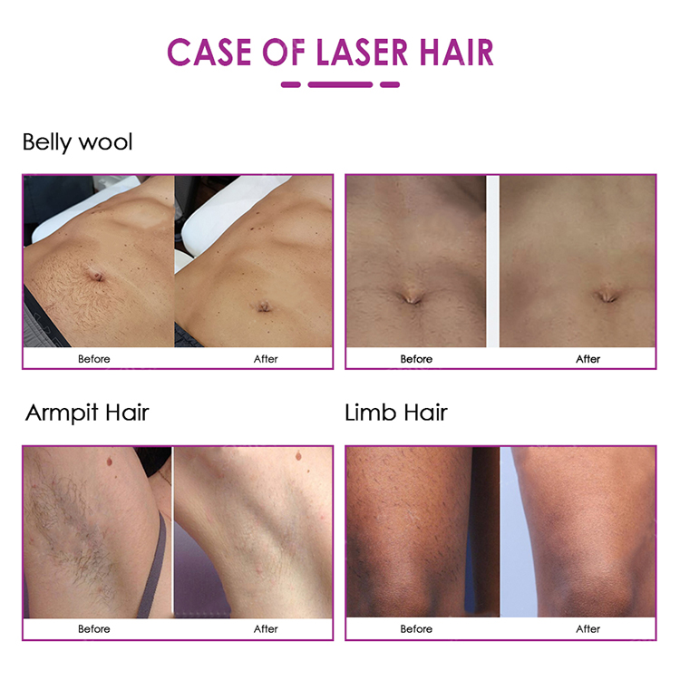 Portable 808 808nm Diode 3 Wavelength Laser Permanent Hair Removal Depilation Skin Rejuvenation Cooling Technology Machine