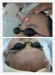 best selling Light spot 0.1mm USA fractional CO2 laser scar/ acne removal skin