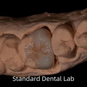 China Translucency Emax Zirconia Dental Inlay Onlay Crown For Restore Natural Cavity Shape wholesale