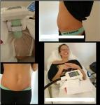 No Downtime 3 Handles Sincoheren Cool Body Sculpting Machine
