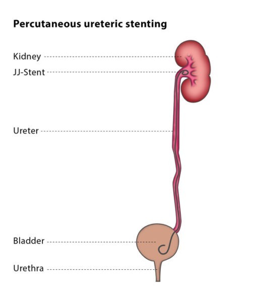 Urology Disposable Lithotripsy Surgical Double J Ureteral Stent