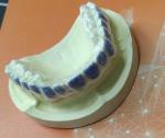 ISO13485 Teeth Whitening Bleach Guard For Smoke Stains