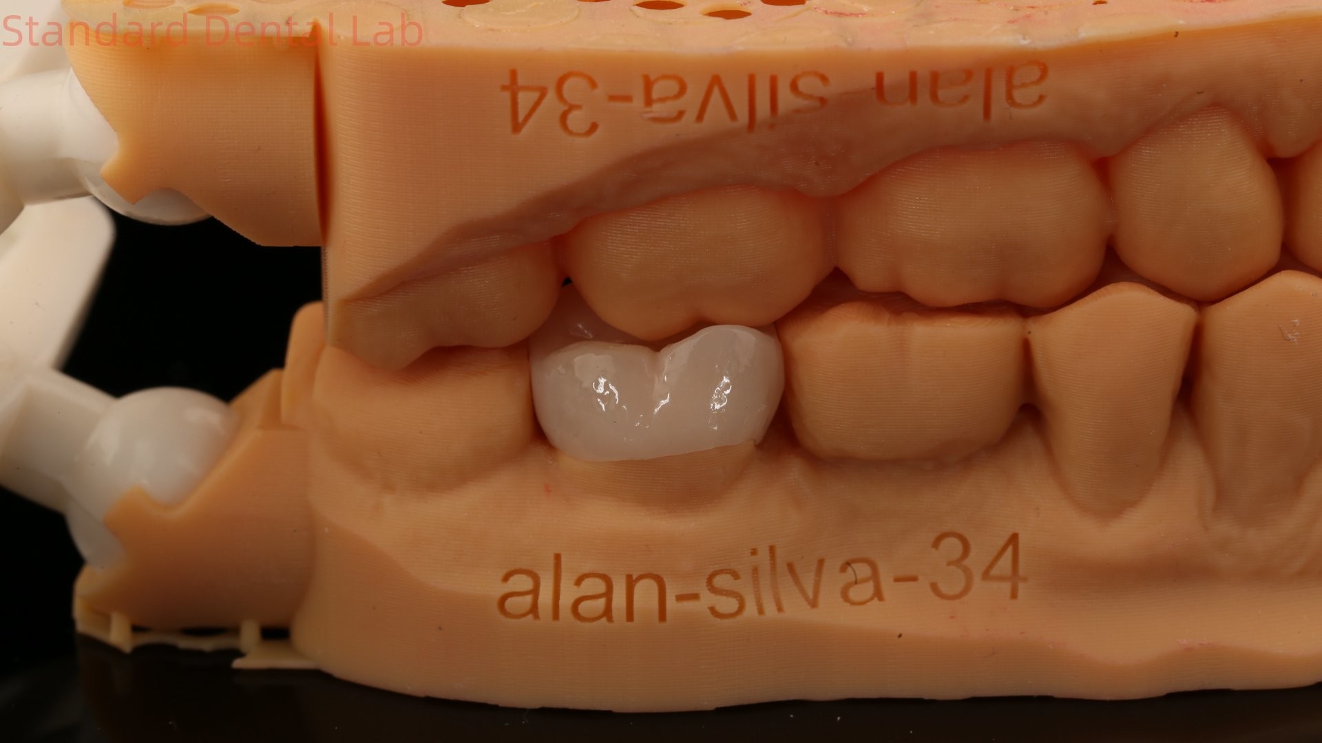 Translucency Dental Zirconia Crown Inlay Onlay Crown For Restore Natural Cavity Shape