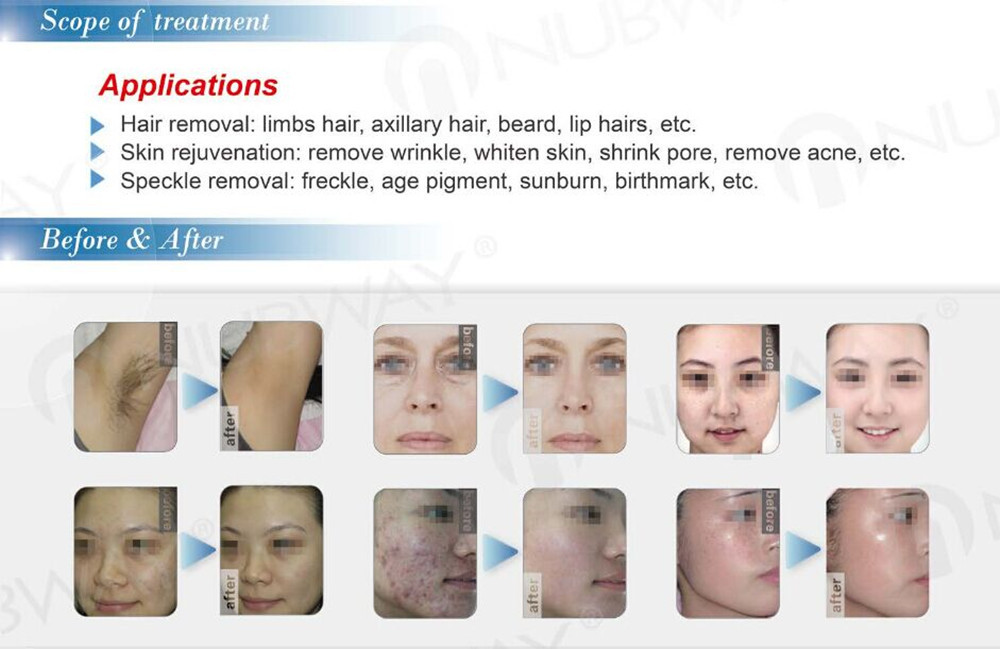 IPL treatment_.jpg