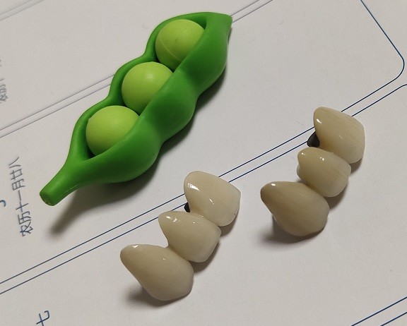 Metal Based Composite Hybrid PMMA Temporary Crown