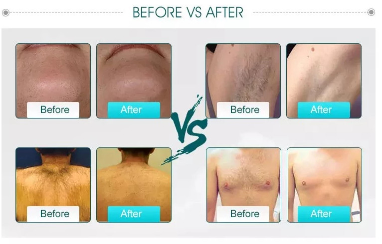 755nm 808nm 1064nm diode laser hair removal products machine/painless diode laser hair removal