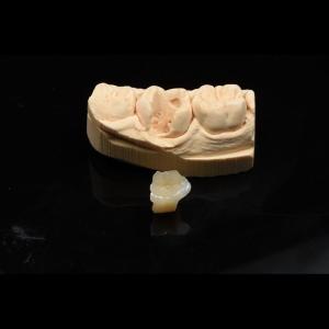China Metal Free Composite Crowns Inlays And Onlays Bridges Implants ODM wholesale