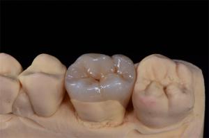 China Minimally Invasive Zirconia Crown for Natural Smile Design wholesale