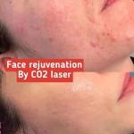 60W Fractional Skin Resurfacing Acne Treatment Anti Puffiness CO2 Laser