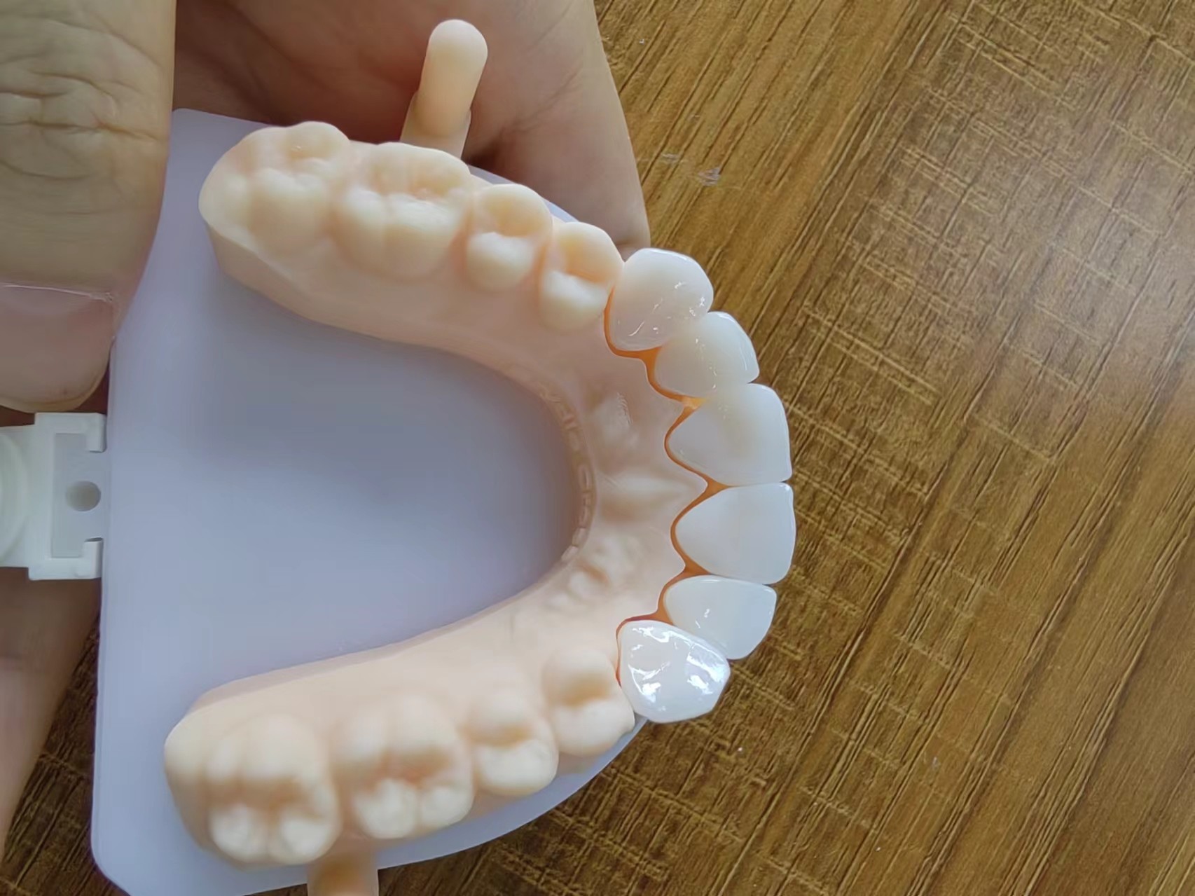 Highly Translucent Layered Zirconia Crowns Natural With Implant Crown