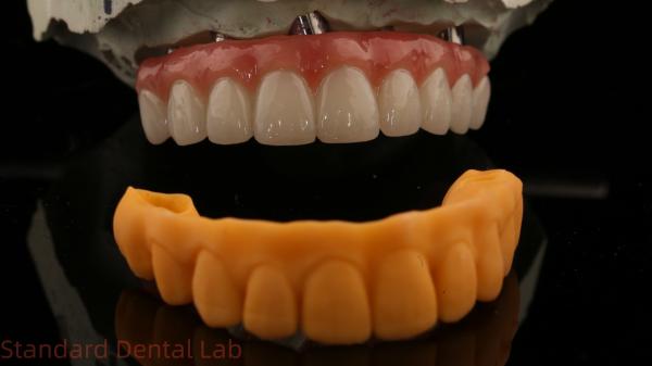 5 Year Guarantee Dental Implant Crown PMMA Bridge Over Multi Unit Abutments