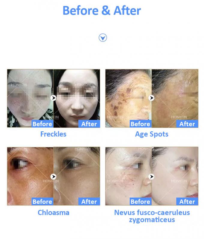 Picosecond Laser Beauty Machines For Pigmentation Lesions Treatment Tattoo Removal 2