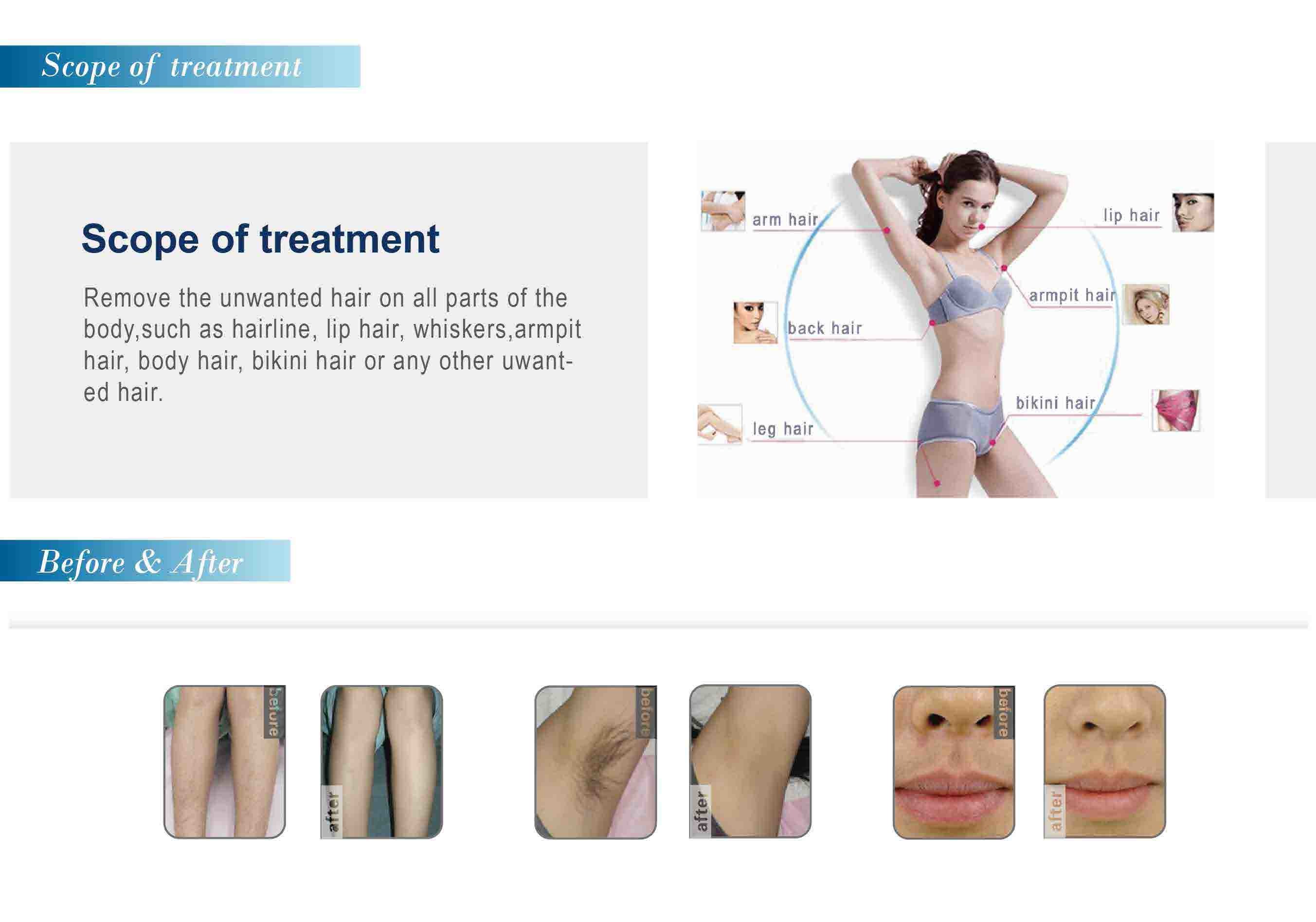 Alexandrite laser 755nm hair removal equipment professional laser hair removal