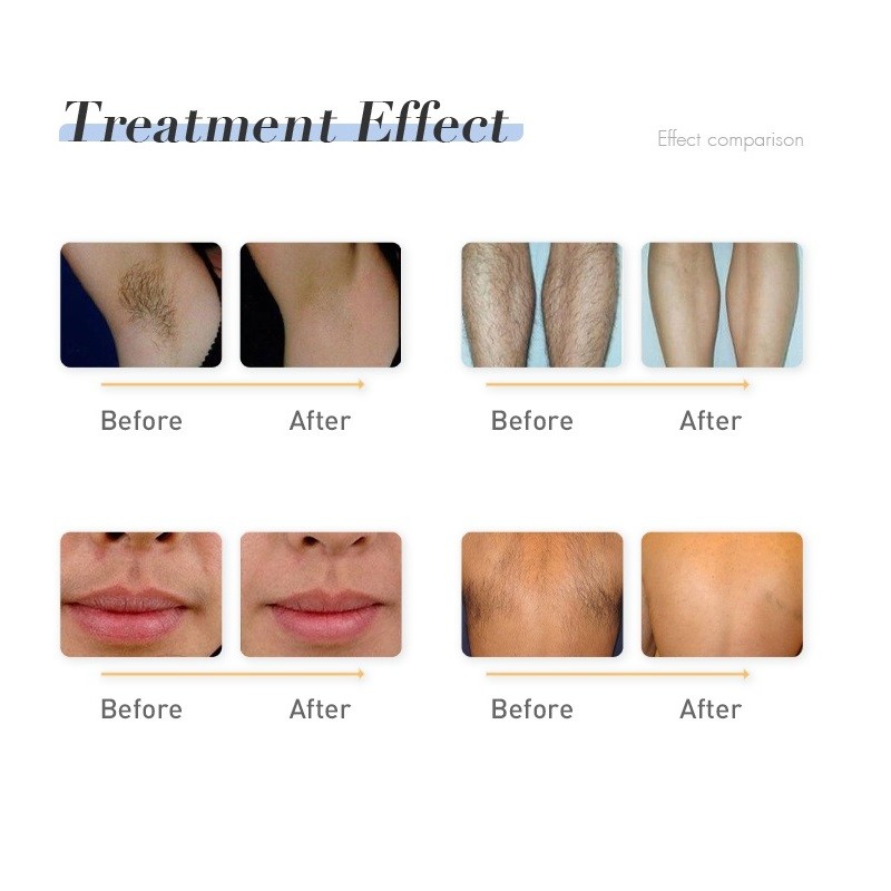 Professional Permanent IPL Hair Removal Machine 808nm Diode Laser Skin Rejuvenation Machine