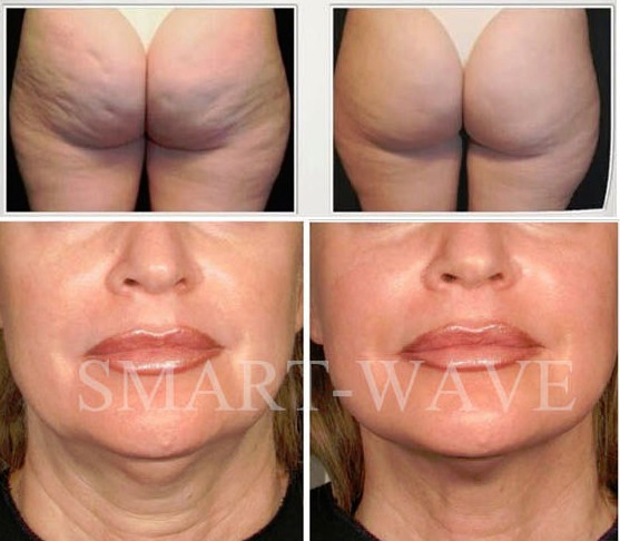 High Precision Acoustic Wave Therapy Shockwave Therapy Equipment For Cellulite / Fat Reduction