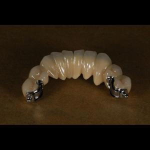 China Aesthetic Partial Denture Precision Attachments Medical Grade OEM wholesale