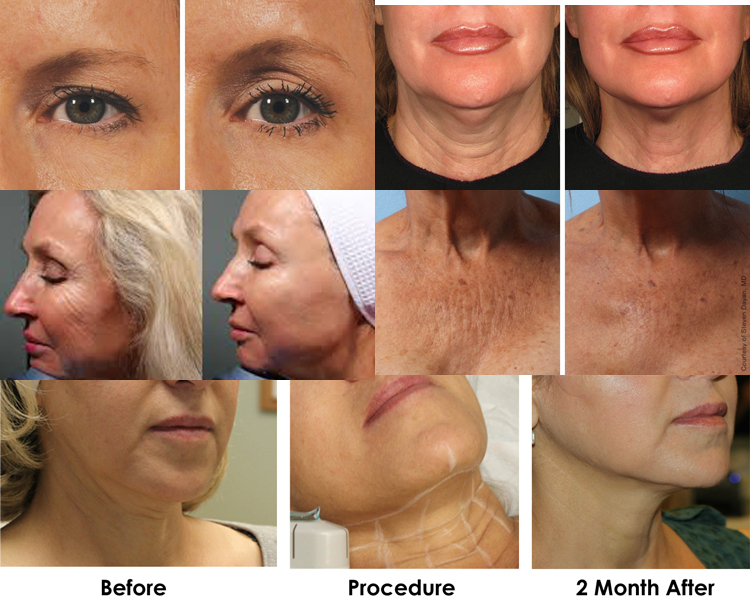 portable radio frequency hifu face lift device best skin tightening machine for sale