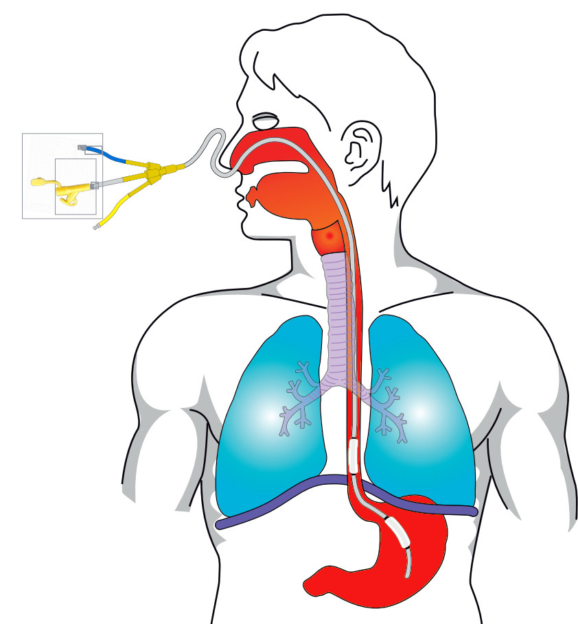 Enteral Feeding Tube With One / Two Balloons For Esophageal Pressure Measurement