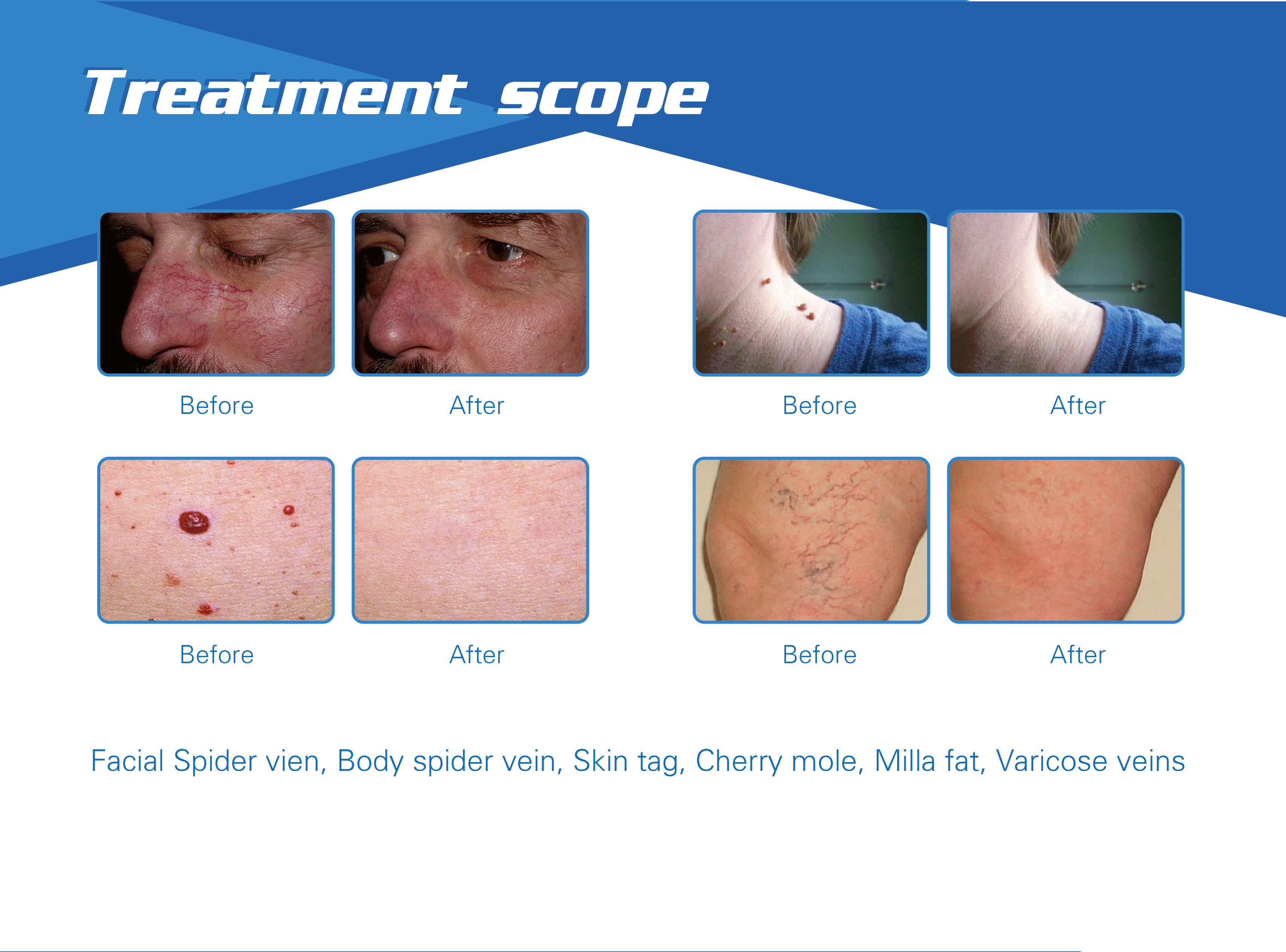 vein removal laser 980nm spider vein removal machine vascular remover